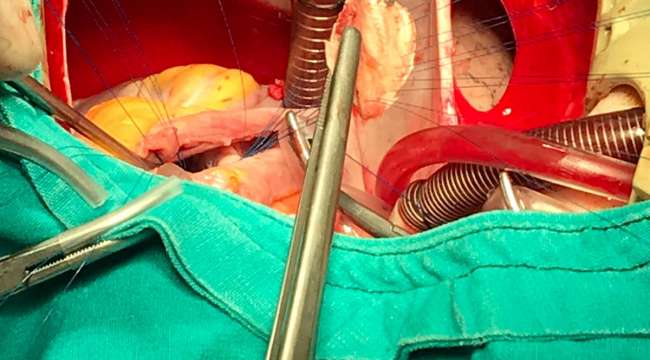  İki Farklı Kalp Deliği Tek Operasyonla Kapatıldı